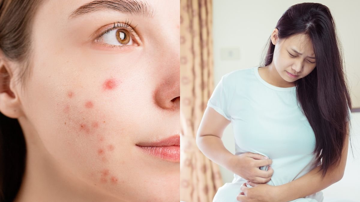 पाचन समस्याओं के लिए मुँहासे: उच्च तनाव के स्तर के असामान्य संकेत जिन्हें आपको ध्यान देना चाहिए