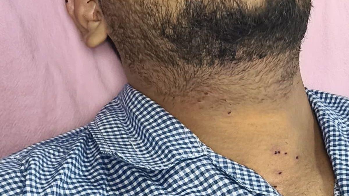 परिवार का कहना है कि गोली लगने से 19 वर्षीय युवक की दाहिनी आंख की रोशनी जा सकती है